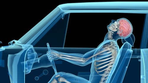 Do You Know Which Are the Most Common Injuries from a Car Accident?