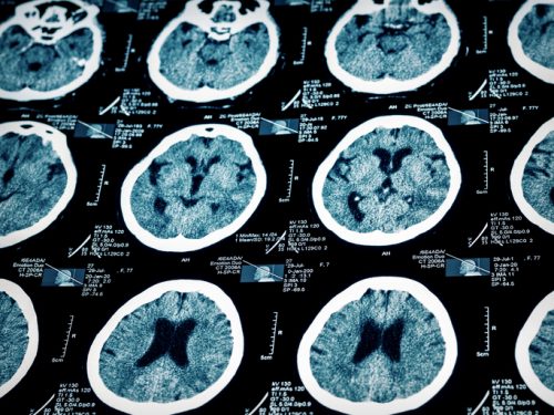 Why You Should Get Follow Up Care If You Have Suffered a Brain Injury