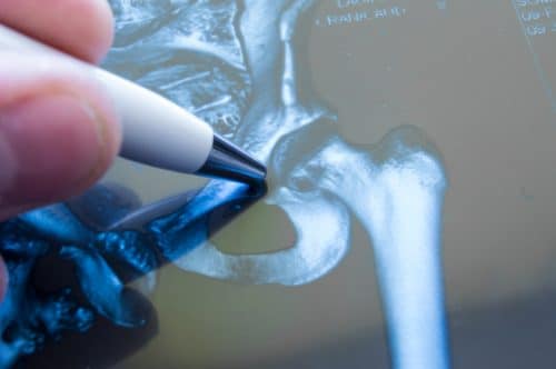 Injury Facts: What is an Intracapsular Hip Fracture?