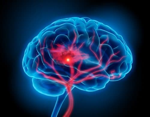 Learn How Brain Shockwaves Could Be Used to Determine the Severity of Brain Injuries