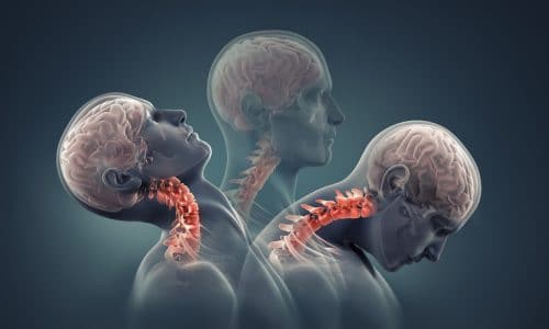 Neck Injuries Are Common After Car Accidents: Learn What to Do if You Suffer from One