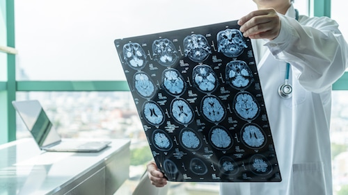 The Four Main Types of Traumatic Brain Injury and What They Mean for Your Personal Injury Case