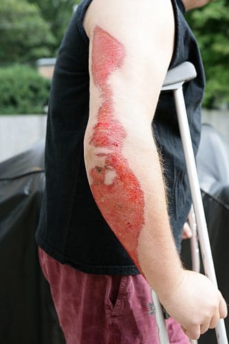Three Types of Injuries Motorcycle Accidents Often Cause