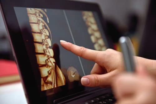 Key Professionals You Need to Hire After a Spinal Cord Injury
